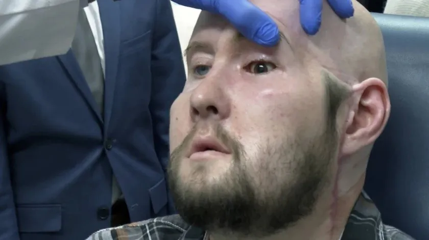 Logran primer trasplante de ojo en Hospital de New York
