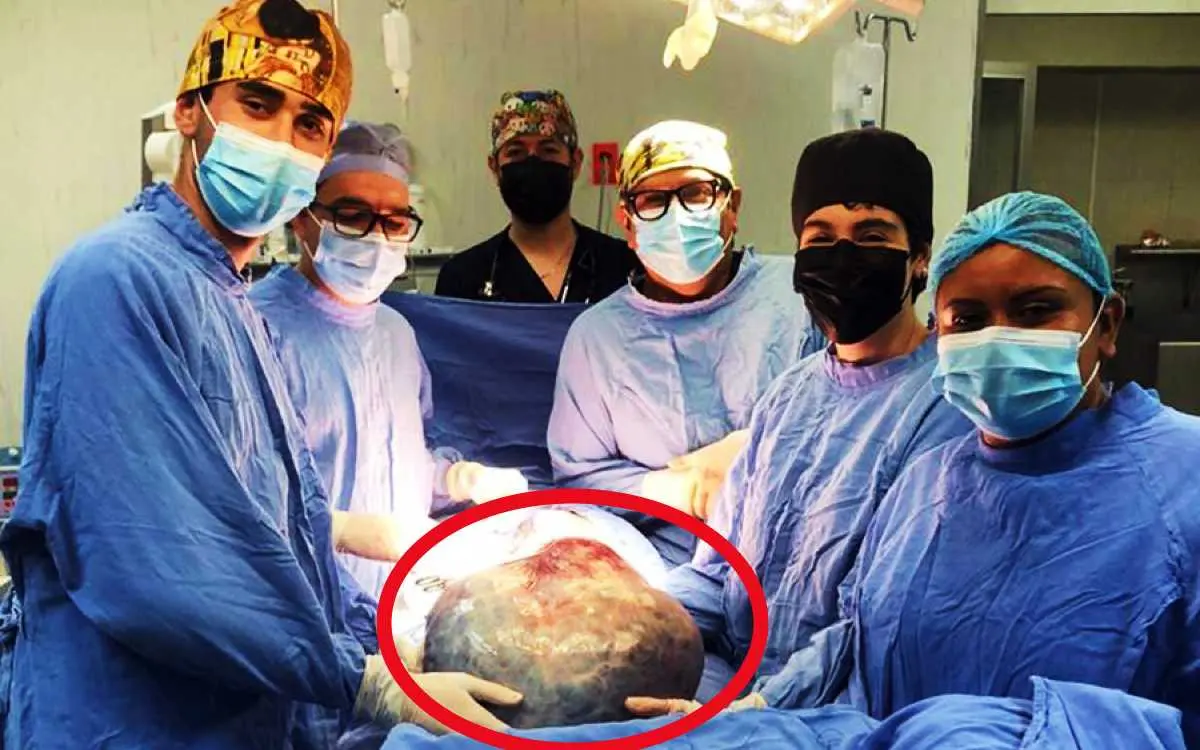 Logran retirar un tumor de 21 kilos a una mujer en el IMSS de Guanajuato