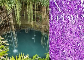 Bacteria que puedes contraer en cenotes Histoplasmosis