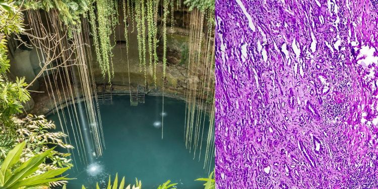 Bacteria que puedes contraer en cenotes Histoplasmosis