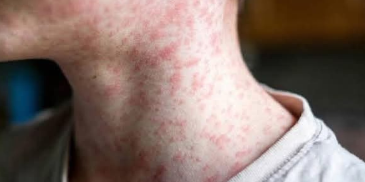Urge Reforzar Vacunación por Sarampión en México