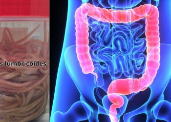 Extraen 142 lombrices intestinales a un niño en Chiapas caso grave de ascariasis