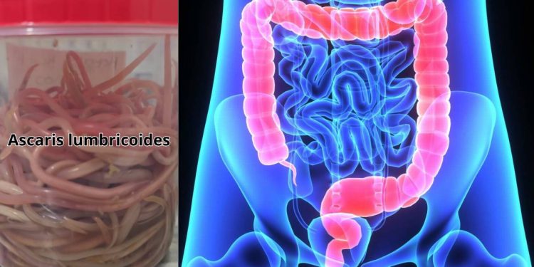 Extraen 142 lombrices intestinales a un niño en Chiapas caso grave de ascariasis
