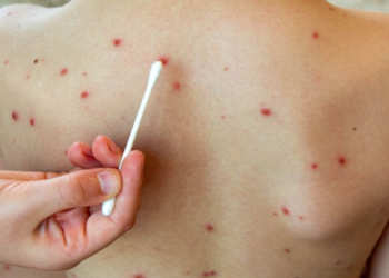 Niño con sarampión en Bacalar atendido por personal medico