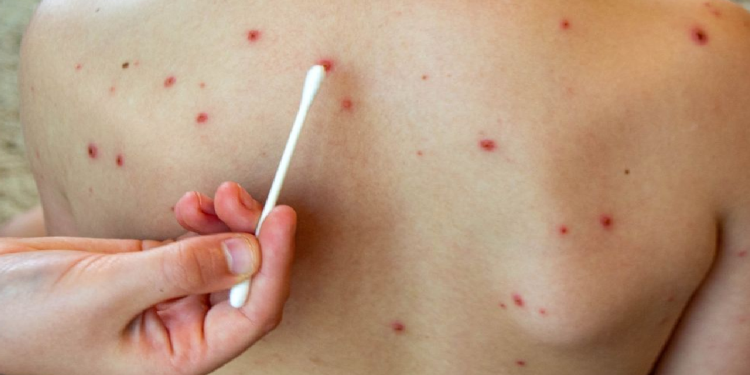 Niño con sarampión en Bacalar atendido por personal medico