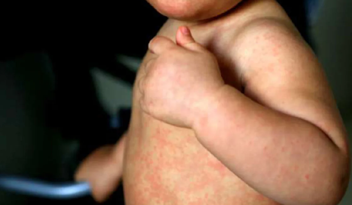 Niño muestra sarpullido característico del sarampión en rostro y cuello