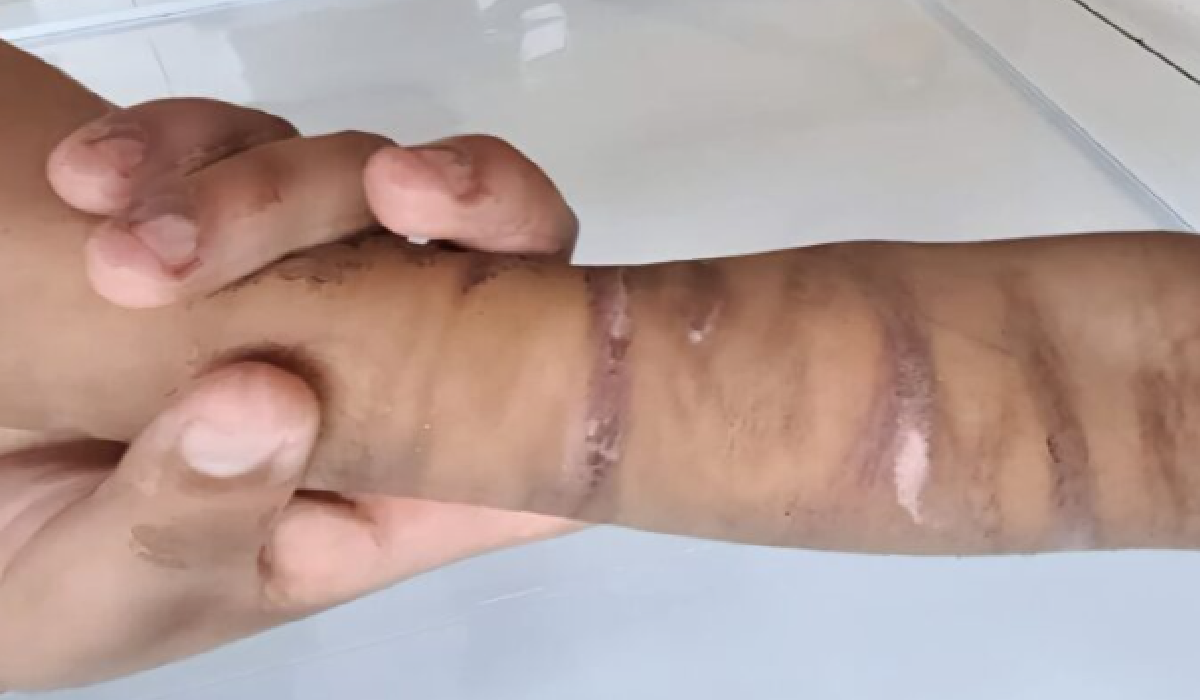 Cicatrices visibles en el brazo del menor víctima de maltrato en Puerto Aventuras