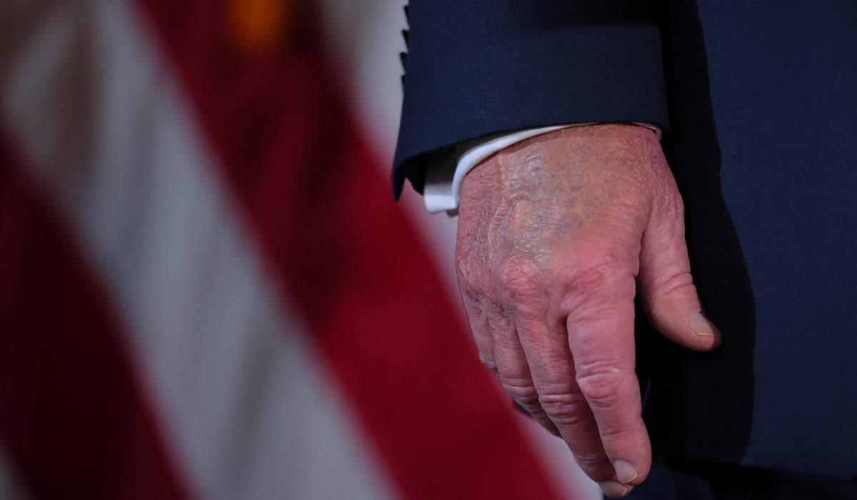 Manos de Donald Trump con hematomas visibles