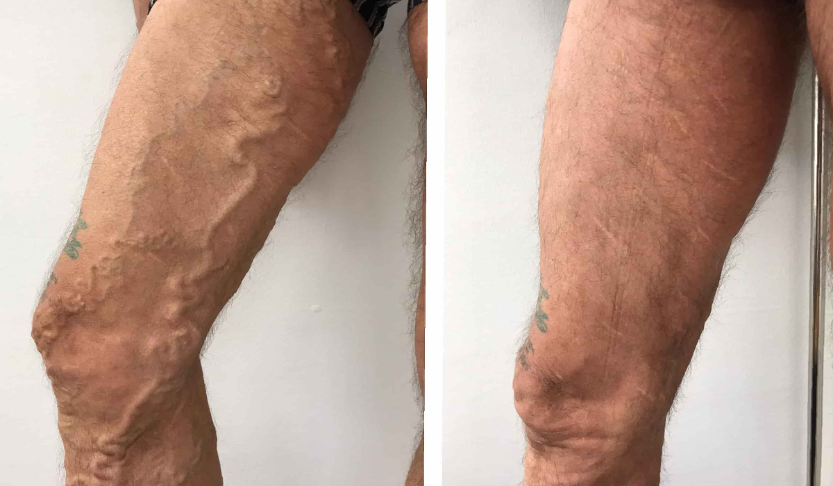 Ejemplos visuales de insuficiencia venosa crónica en piernas