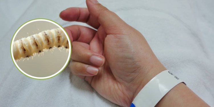 Primer caso humano de gusano barrenador en Estados Unidos en 2025