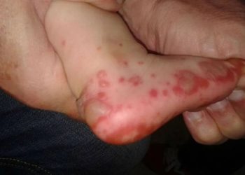¡ALERTA! Campeche confirma 49 casos de Coxsackie