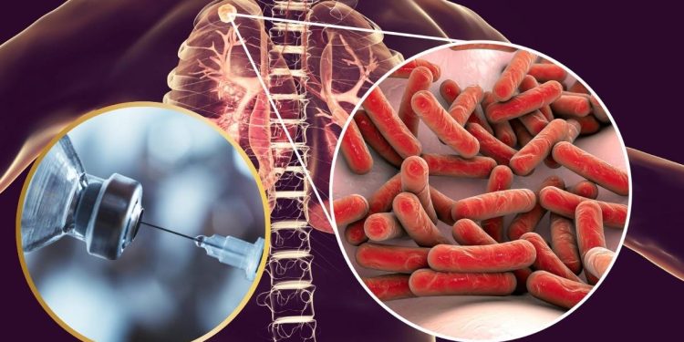 Liberan la vacuna BCG en Mexico nueva esperanza contra la tuberculosis