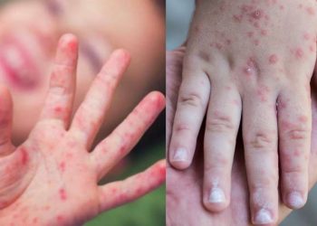 Virus Coxsackie: la enfermedad que preocupa a padres en México — síntomas, contagio y tratamiento