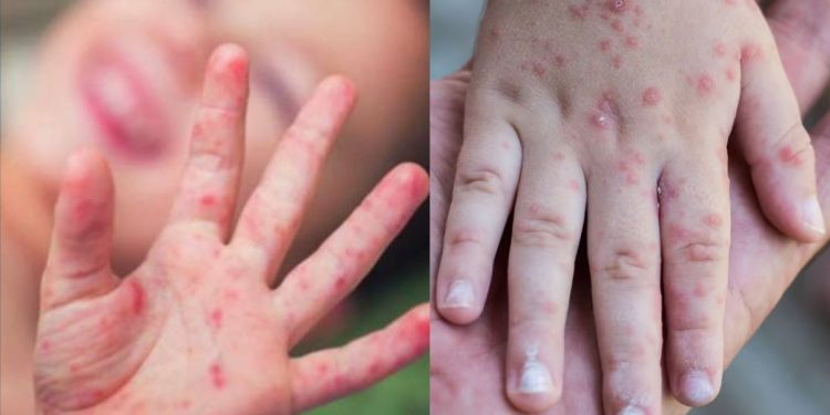Virus Coxsackie: la enfermedad que preocupa a padres en México — síntomas, contagio y tratamiento
