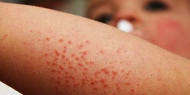 Virus Coxsackie: la enfermedad que preocupa a padres en México — síntomas, contagio y tratamiento