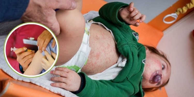 Sarampion que es a quienes afecta mas y por que preocupa el brote en Mexico